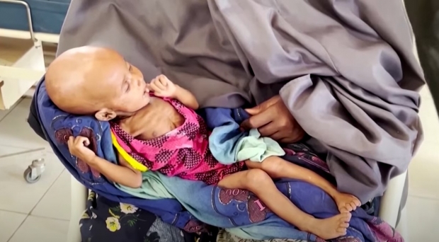 소말리아 어린이 / 영양실조 심각, 갈수록 심각화  / 사진 : 뉴스통신사 비디오 캡처