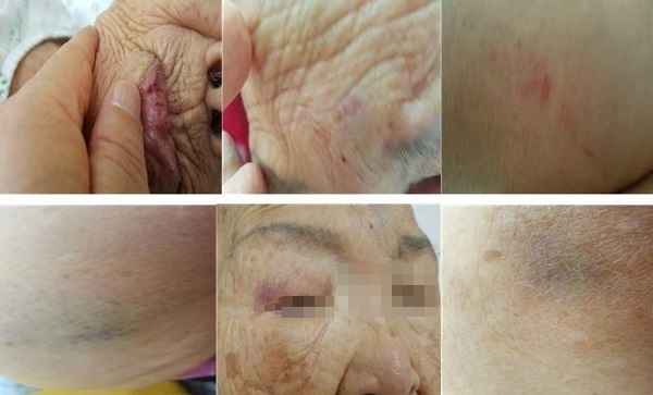 ▲환자 김 씨(여, 94세)가 간병인에게 폭행당해 발생한 입술, 이마, 양쪽 눈, 허벅지, 어깨, 다리 등의 상처. (사진 =제보자 이모씨 제공)