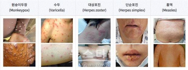 발진 비교사진 (출처:질병관리청)