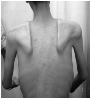 사진설명: 근위축성 이영양증 (Myotonic Dystrophy Type 1: DM1)에 의해 호흡근 및 전신근육이 결함 된 환자